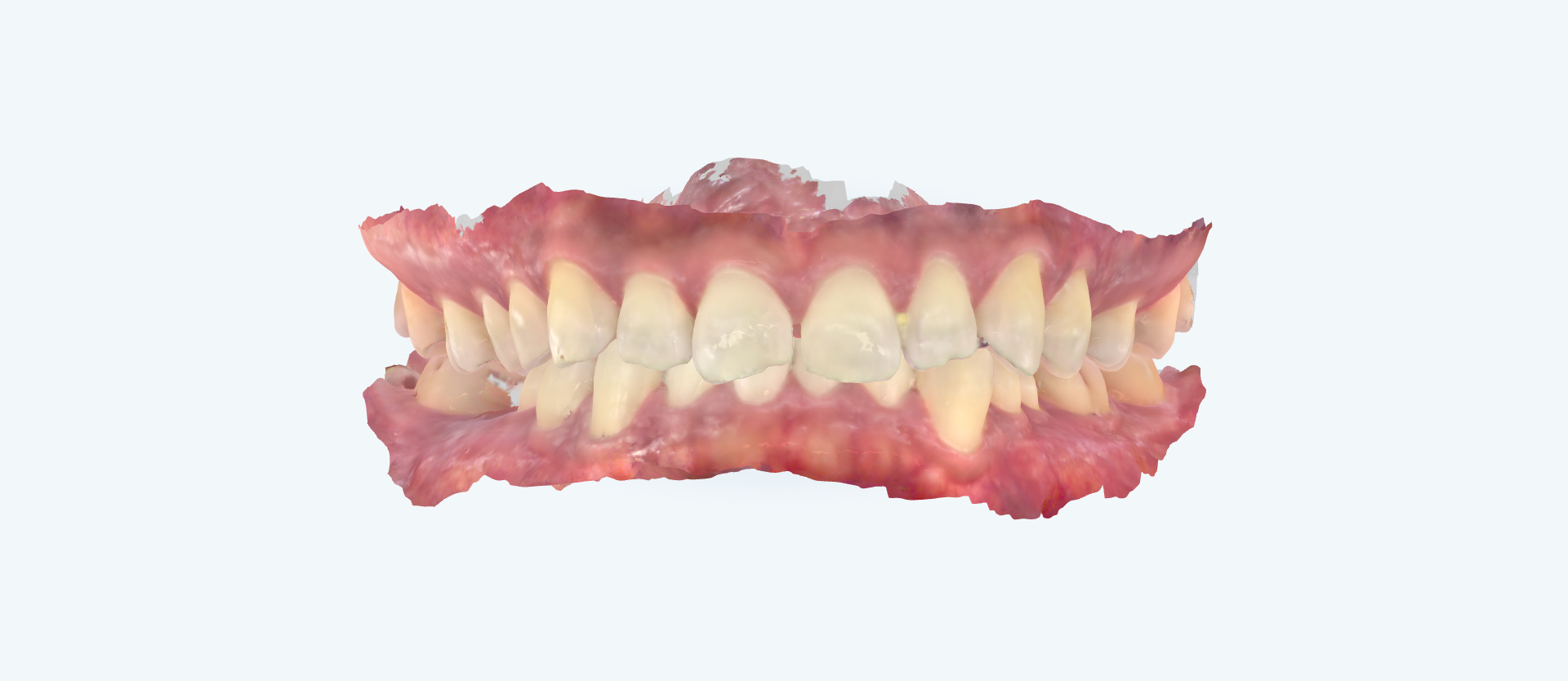 Overbite treatment comparison case 3 before